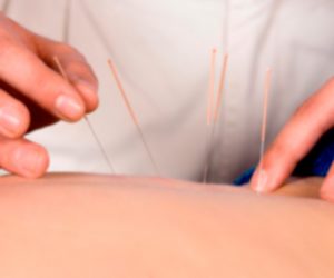 medical acupuncture ajax